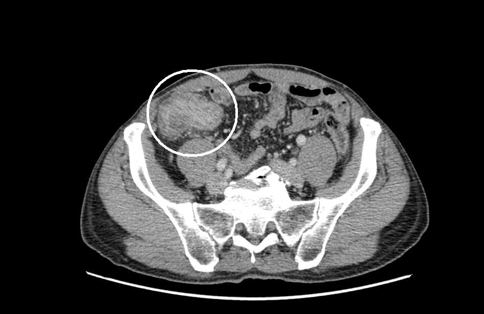 Fig. 1 Computed Tomography (CT) scan demonstrating the colonic tumour shown circled.